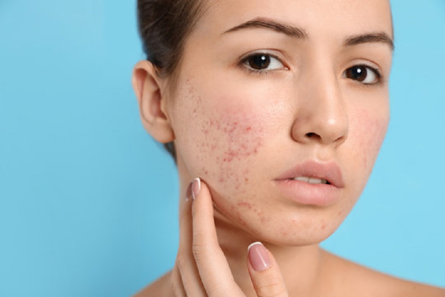 Best Acne Treatment For Sensitive Skin Reaching World Live