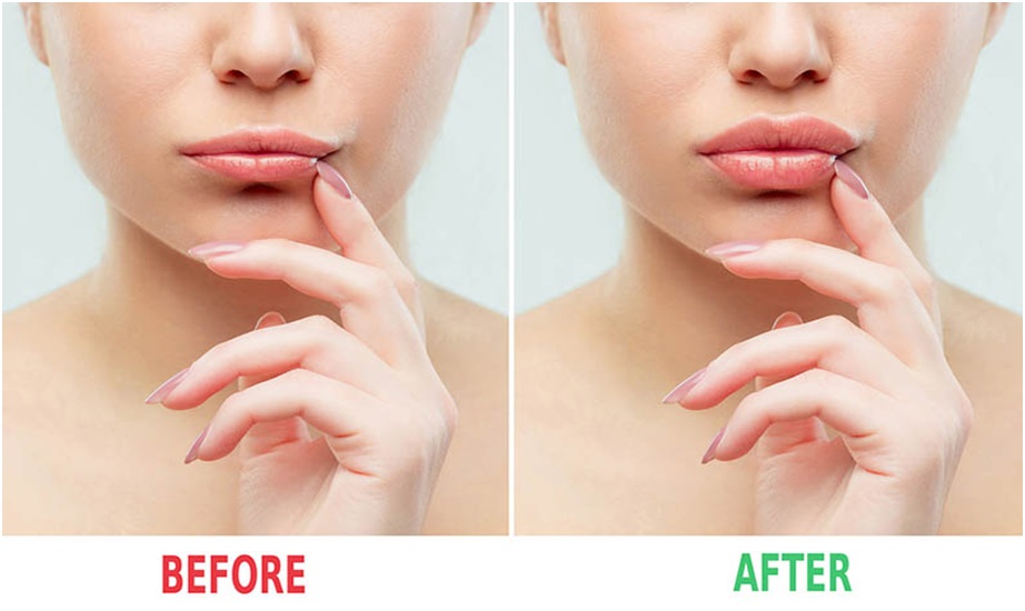 lip filler before after