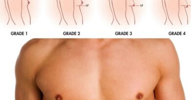 Gynecomastia Surgery