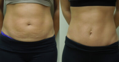 tummy tuck surgery in India