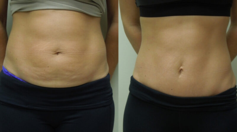 tummy tuck surgery in India