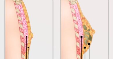 Breast Reduction Surgery in India