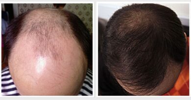 hair transplant in Ludhiana