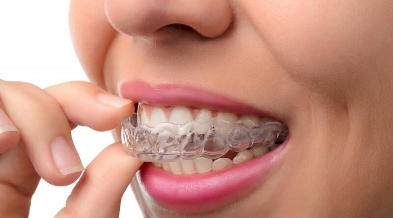 Straight Teeth with Clear Aligners