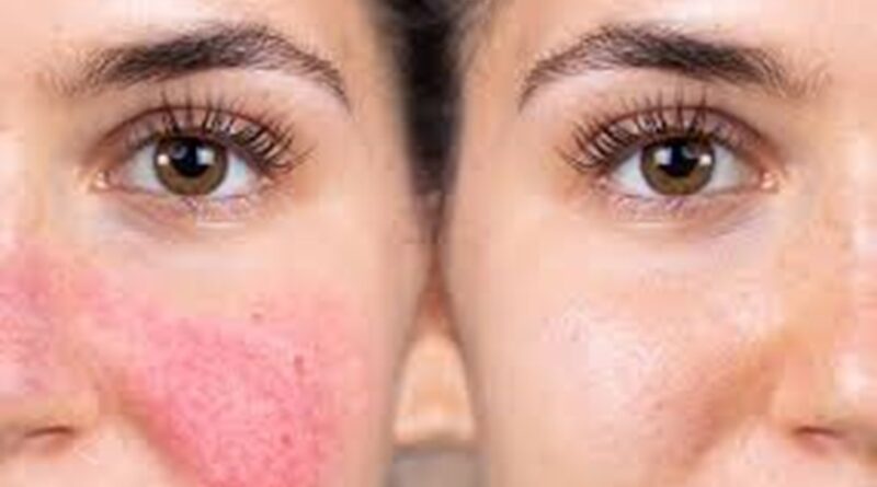 Exploring Non Invasive Solutions for Facial Redness Treatment